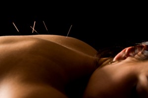 Acupuncture - Portland Naturopathic Doctor